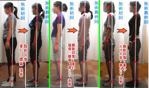 骨盤＋姿勢矯正のビフォーアフターがスゴイ