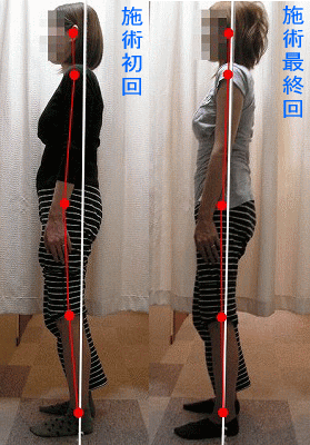 骨盤・姿勢矯正