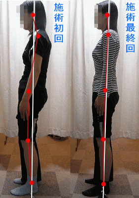 骨盤後傾からの腰痛