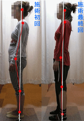 骨盤・姿勢矯正