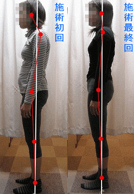 骨盤・姿勢矯正