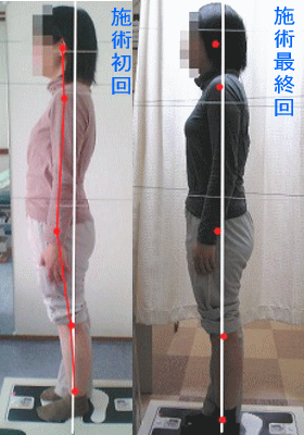 骨盤・姿勢矯正