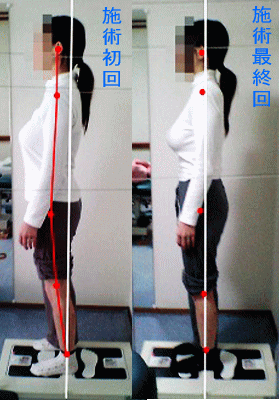 骨盤・姿勢矯正