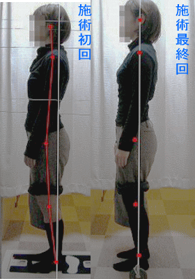 骨盤・姿勢矯正