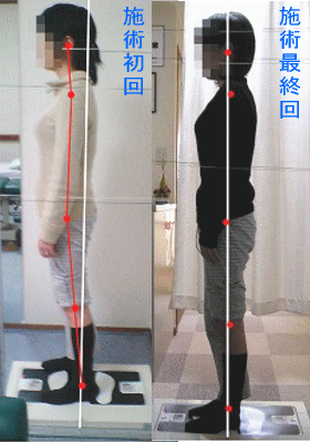 骨盤・姿勢矯正