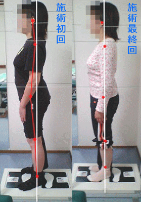 骨盤・姿勢矯正