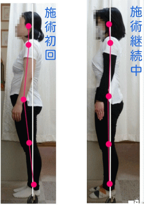 骨盤・姿勢矯正