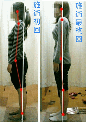 過度な反り腰からの腰痛