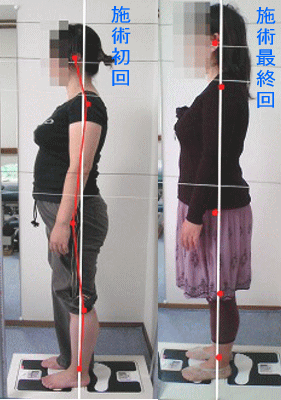 骨盤・姿勢矯正