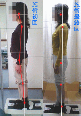 骨盤・姿勢矯正