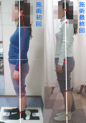 骨盤・姿勢矯正