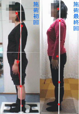 骨盤・姿勢矯正