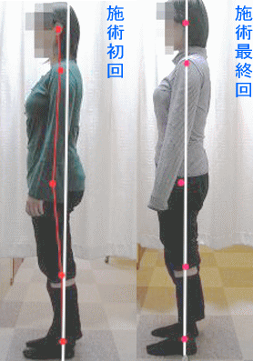 骨盤・姿勢矯正