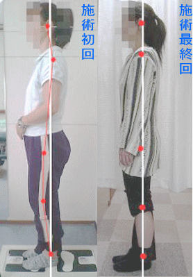 骨盤・姿勢矯正