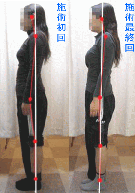 骨盤・姿勢矯正