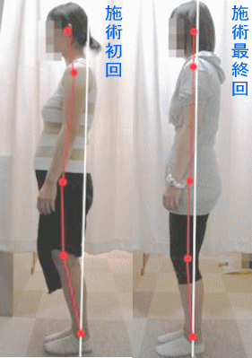 骨盤・姿勢矯正