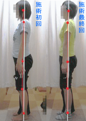 骨盤・姿勢矯正