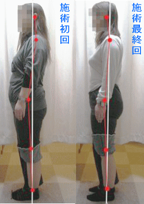 骨盤・姿勢矯正