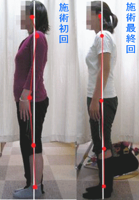 骨盤・姿勢矯正