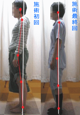 骨盤・姿勢矯正