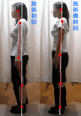 骨盤・姿勢矯正