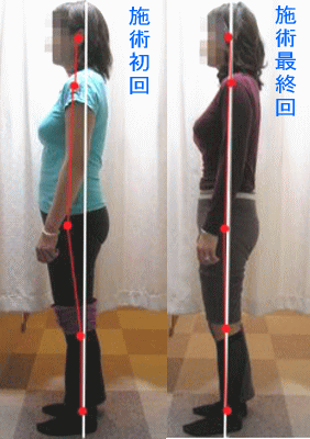 骨盤・姿勢矯正