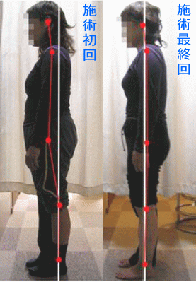 骨盤・姿勢矯正