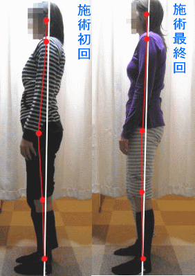 骨盤・姿勢矯正