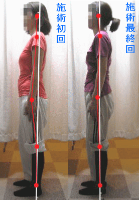 骨盤・姿勢矯正