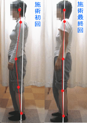 骨盤・姿勢矯正