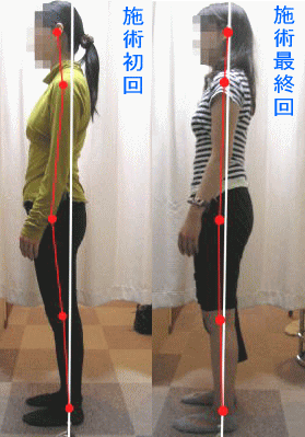 骨盤・姿勢矯正