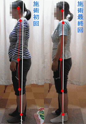 産後の骨盤・姿勢矯正