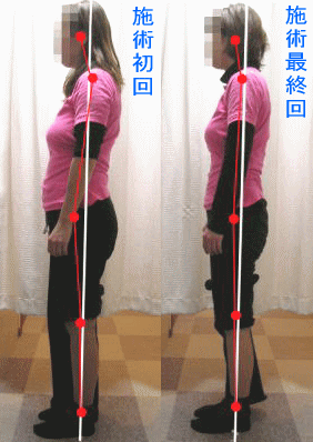 骨盤・姿勢矯正