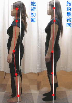 骨盤・姿勢矯正