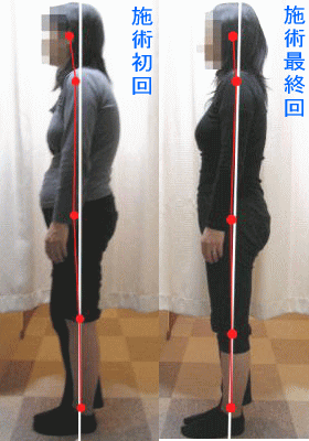 骨盤・姿勢矯正