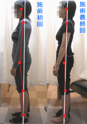 骨盤・姿勢矯正