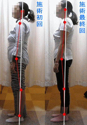 骨盤・姿勢矯正