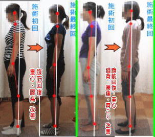 骨盤＋姿勢矯正のビフォーアフターがスゴイ