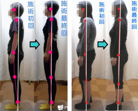 完成度の高い姿勢矯正で腰痛に対応